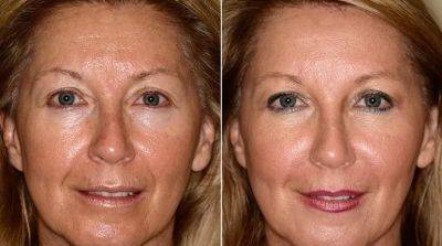 Что такое фейслифтинг? Плюсы и минусы подтяжки лица - beauty-lady.com.ua