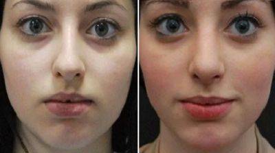 Что такое ринопластика? Показания, осложнения - beauty-lady.com.ua