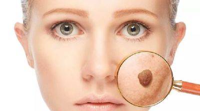 Родинки на лице: тайный смысл и мифы - beauty-lady.com.ua